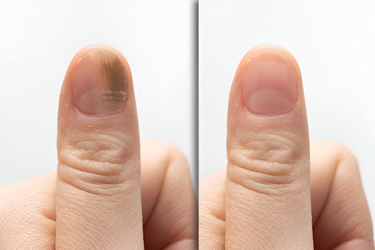 7-Day Nail Revival Patches Rapid Fungal Defense