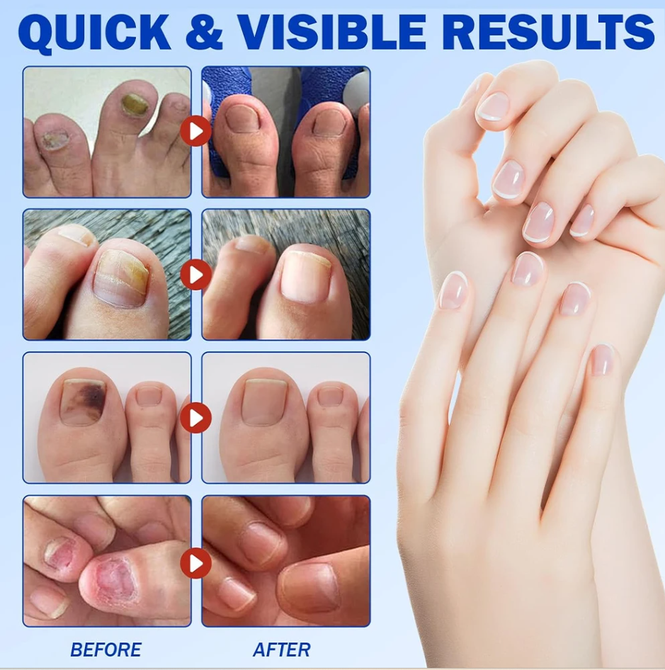 7-Day Nail Revival Patches Rapid Fungal Defense